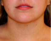 Feel Beautiful - Neck Liposuction 208 - After Photo